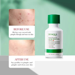 BIOAQUA 35ml acne care serum