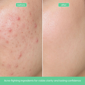 Salicylic acid facial serum for oily skin