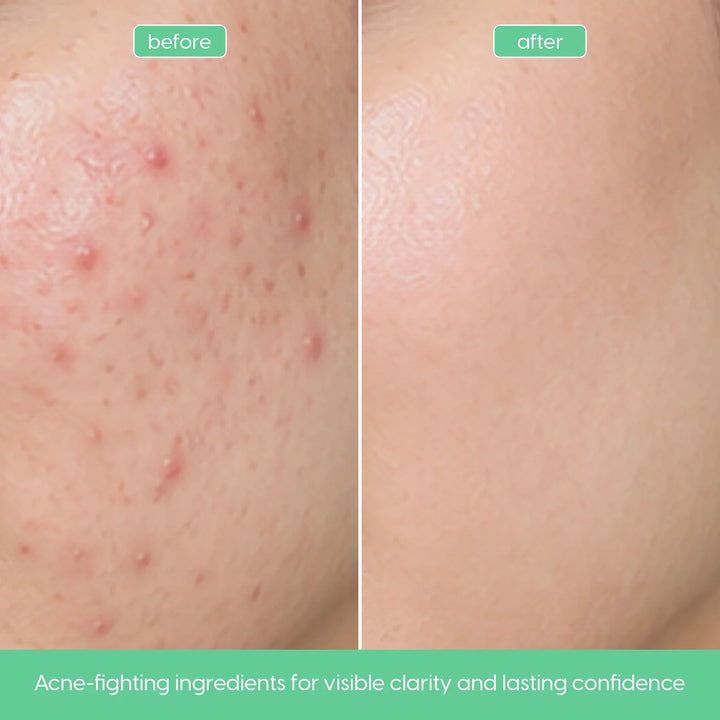 Salicylic acid facial serum for oily skin