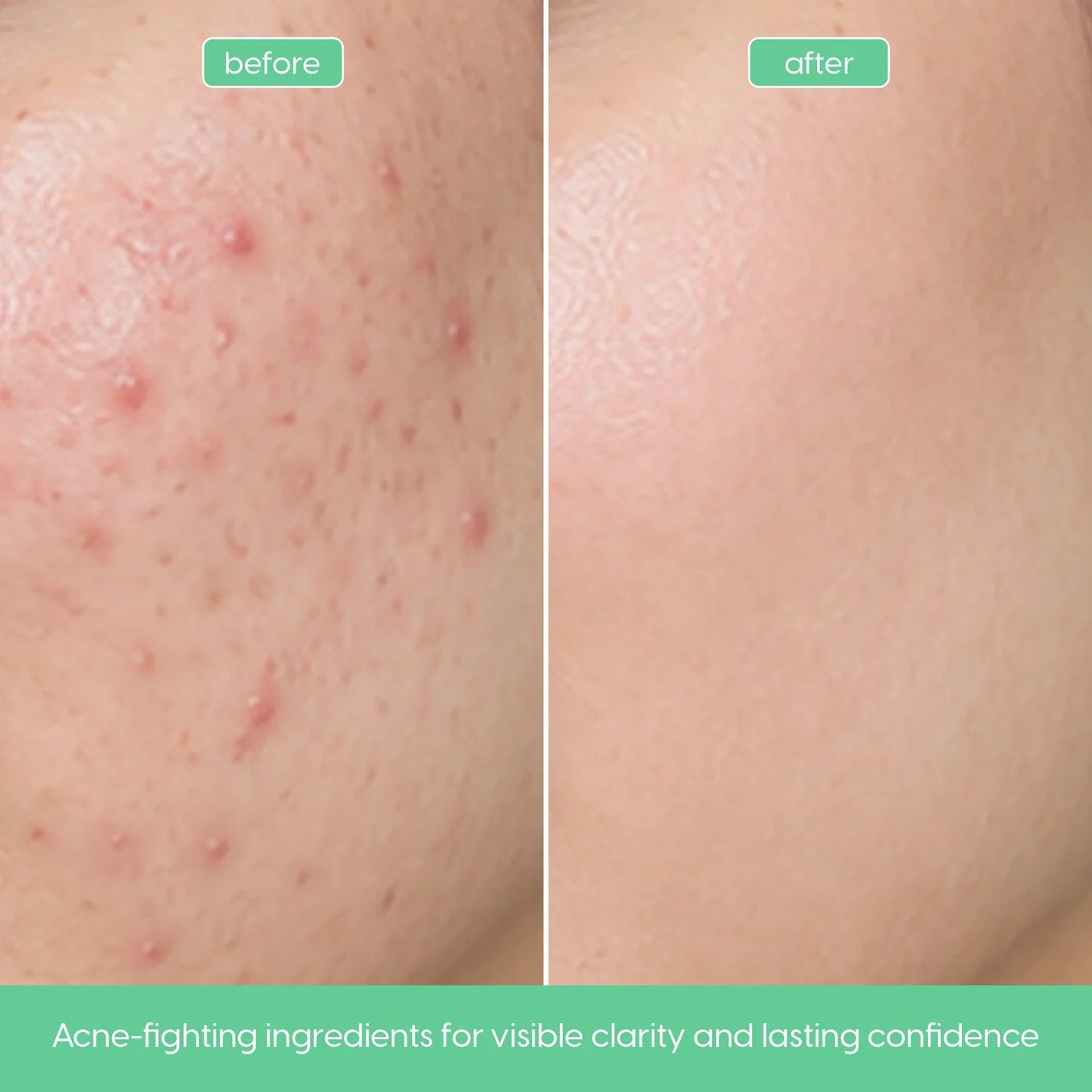 Salicylic acid facial serum for oily skin